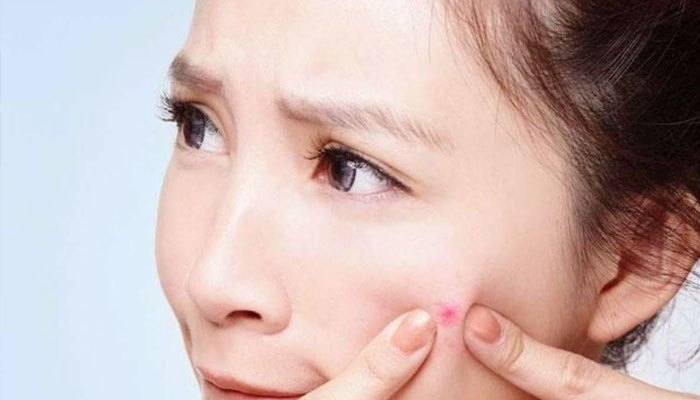 Trị mụn với tủ lạnh