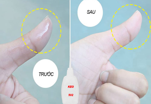 Mẹo tẩy keo 502 dính trên da nhanh chóng | Nguyễn Kim Blog